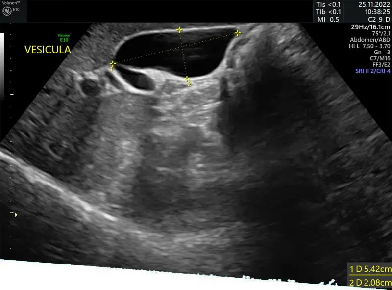 Ultrasonido de abdomen superior en Mérida