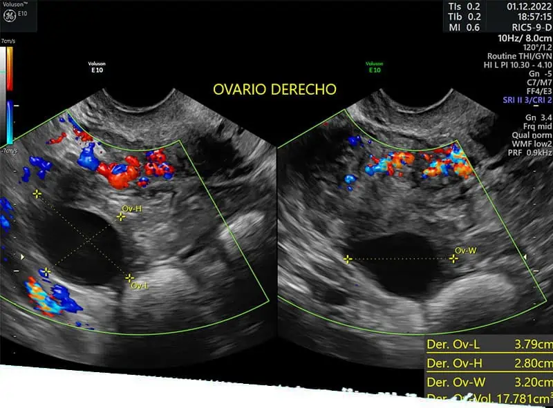 ultrasonido transvaginal en Mérida