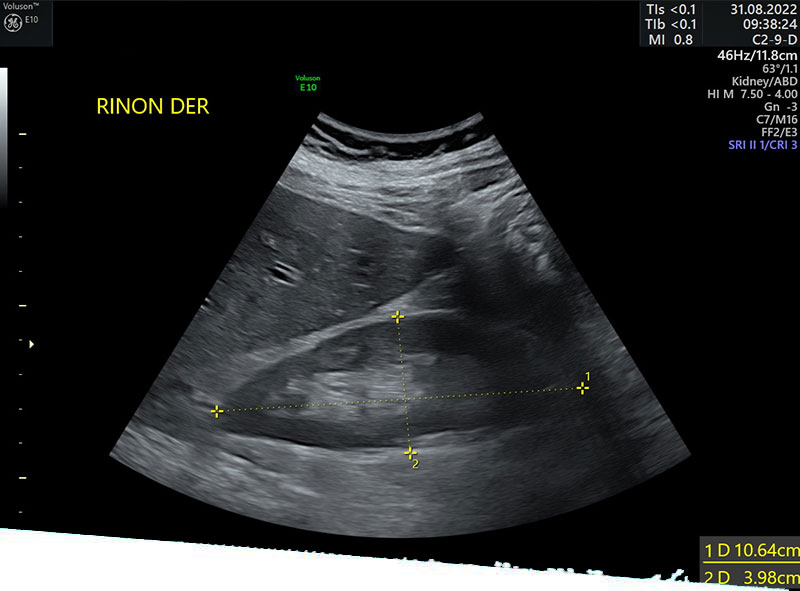 Ultrasonido prostata-renal en Mérida - Ultrasonido renal en Mérida