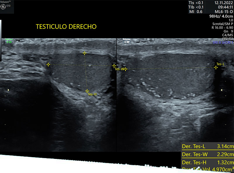 ULTRASONIDO TESTICULAR