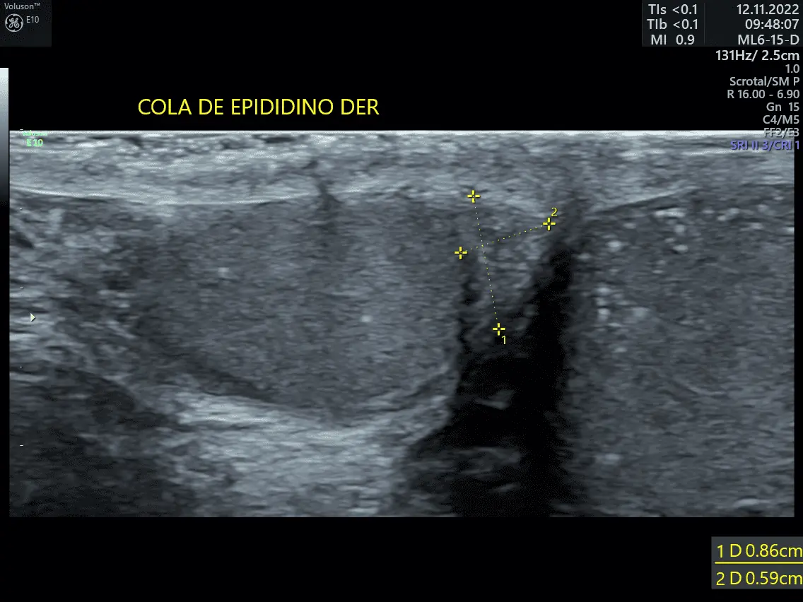 COLA-DE-EPIDIDIMO_1