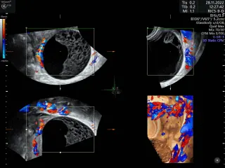 ENDOMETRIOMA-CARACTERIZACION-320x240-2