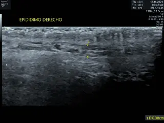 https://ultrasonidoceuldimerida.com/wp-content/uploads/2023/01/EPIDIDIMO-DERECHO-320x240-1.webp