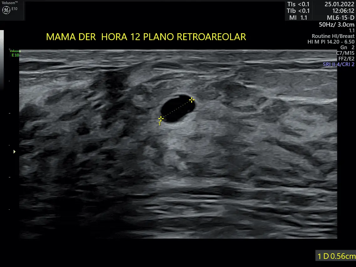 Ultrasonidos de glándula mamaria en Mérida