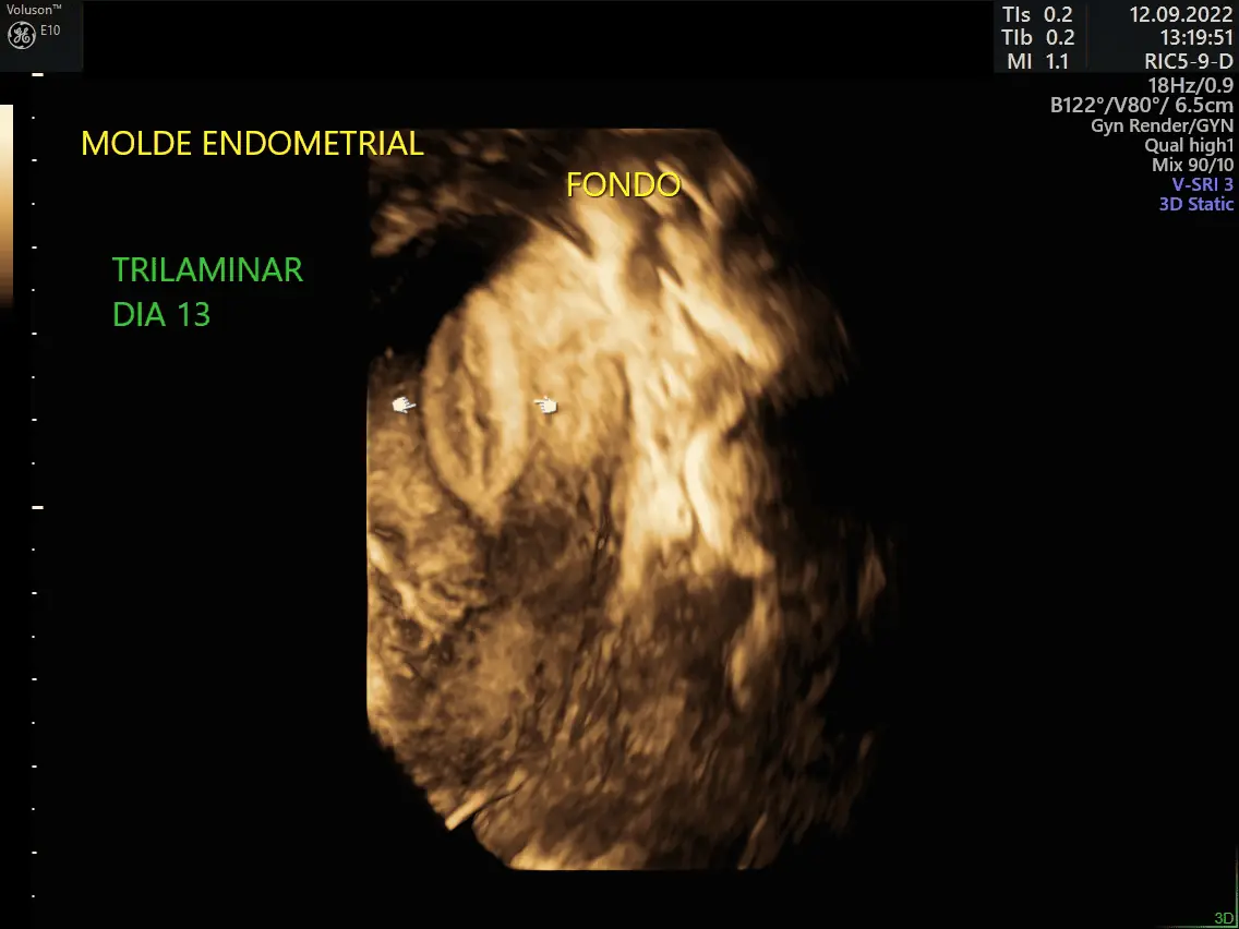 MOLDE-ENDOMETRIAL-TRILAMINAR-1