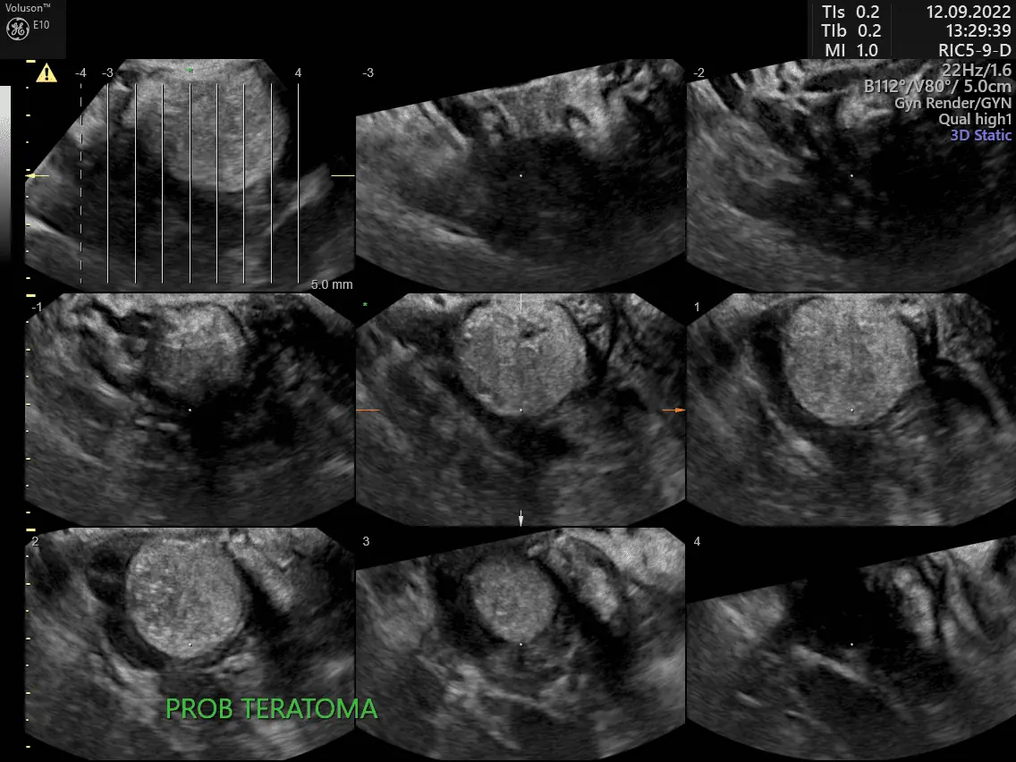 ULTRASONIDO TERAPÉUTICO SONOMEDIC