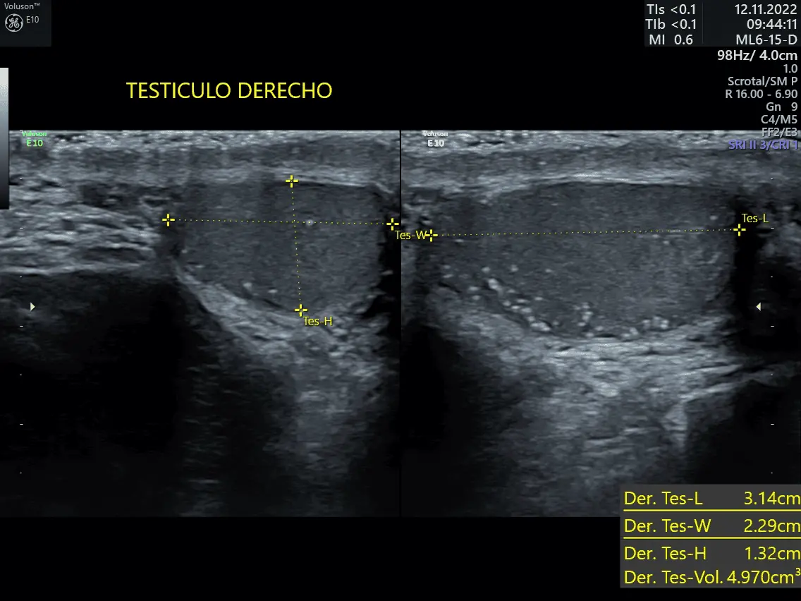 ULTRASONIDO TESTICULO DERECHO - Ultrasonido para Ellos